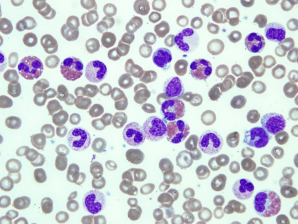 FIG 1. Peripheral blood smear showing leukocytosis with a left shift and absolute eosinophilia with mature eosinophils (Giemsa, 100x magnification, oil)