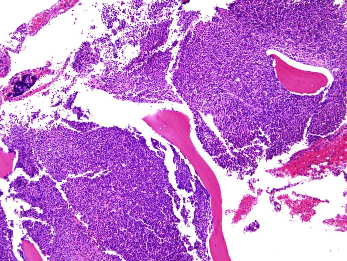 FIG 2. Bone marrow core biopsy, hypercellular, with marked myeloid hyperplasia (H&E, 10x magnification)
