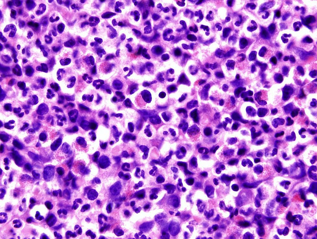 FIG 3. Bone marrow core biopsy showing markedly increased eosinophils along with myeloid expansion (H&E, 100x magnification, oil)