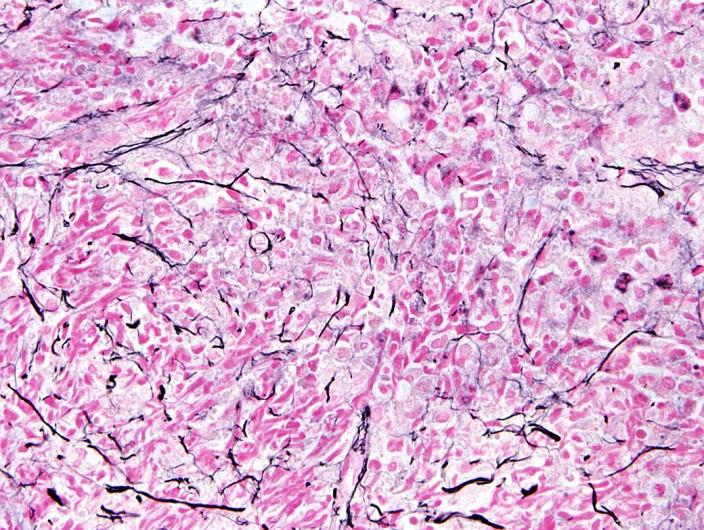FIG 4. Bone marrow core biopsy showing increased fibrosis (Reticulin stain, 100x magnification, oil)