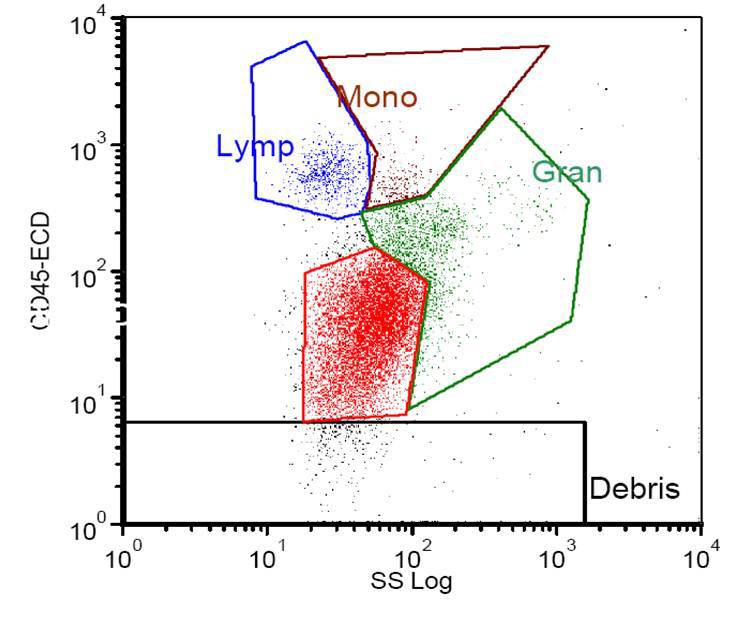 Flow cytometry scatter plot showing a significant population of CD45 dim blasts.