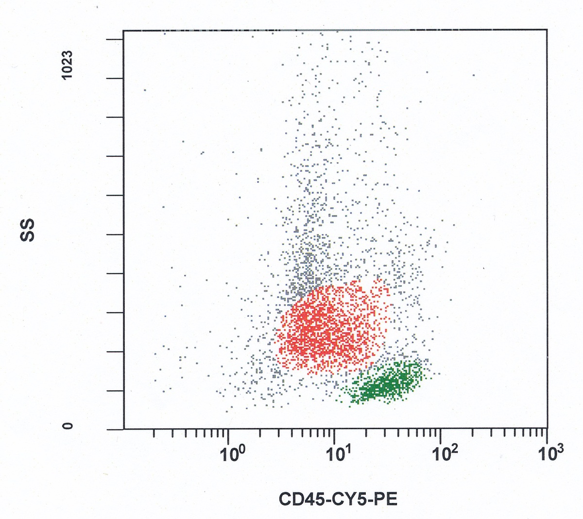 CD45 vs. SSC scattergram showing a prominent population of blasts, residual granulocytic series, lymphocytes and few monocytes