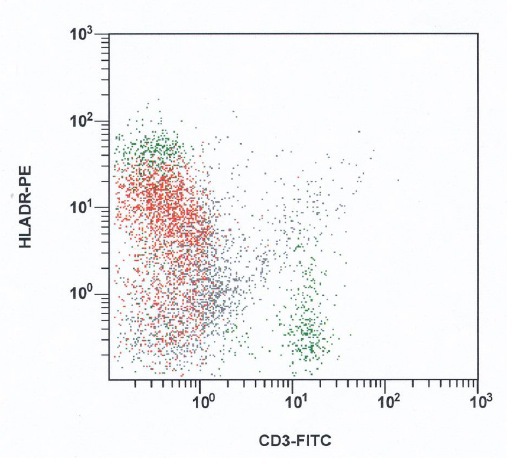 HLA-DR expression in blast population; blasts in red, lymphocytes in green