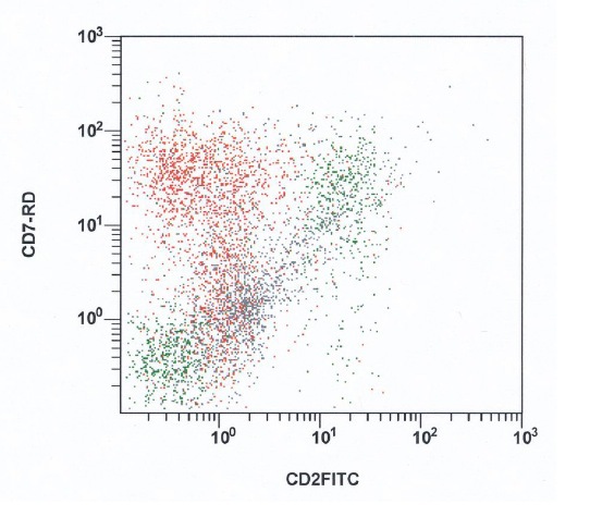 Coexpression of CD7 antigen in a proportion of blasts; blasts in red, lymphocytes in green