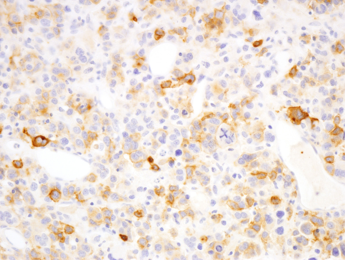 CD117 immunostain, bone marrow (40x)