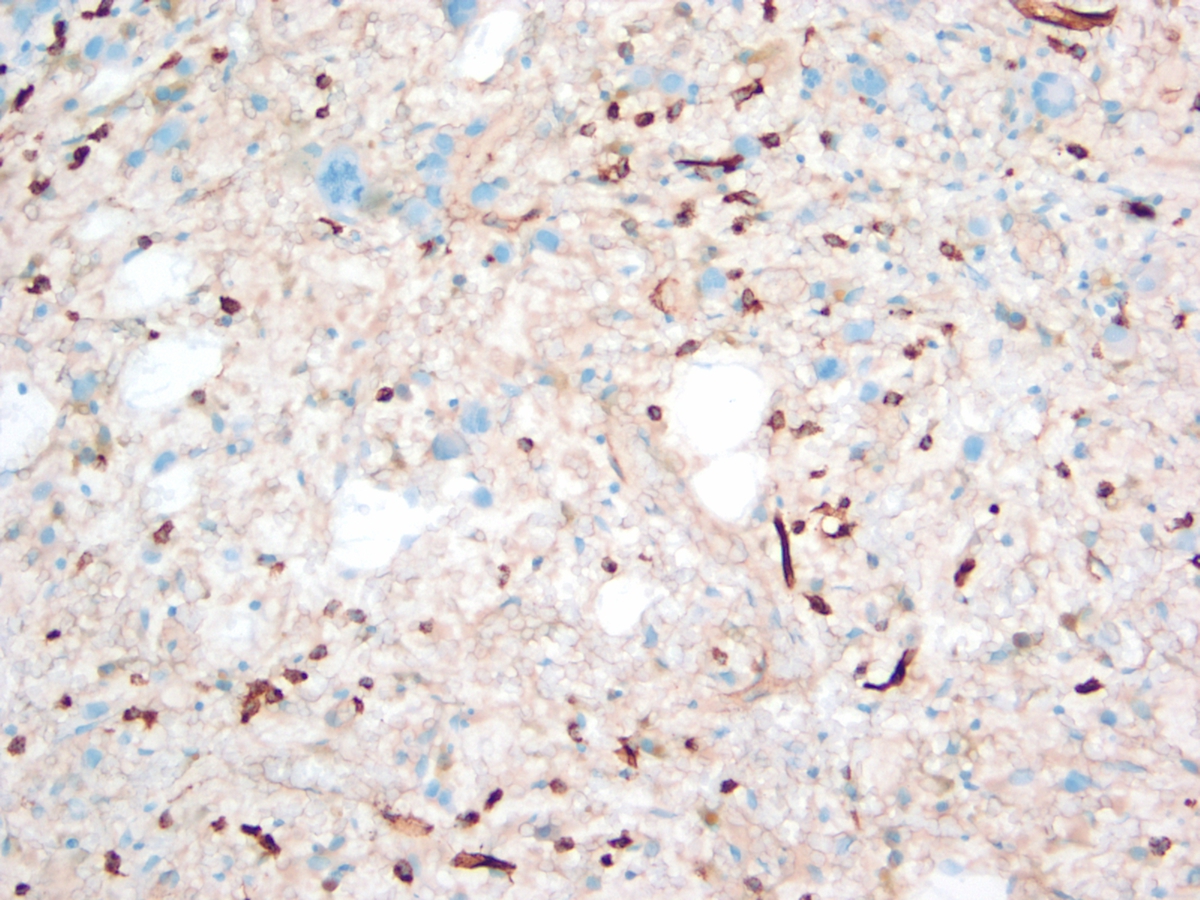 Figure 4. Bone marrow biopsy at day 14 of first induction chemotherapy (CD34, 200x). Microphotograph of an area rich in small CD34-positive blasts.