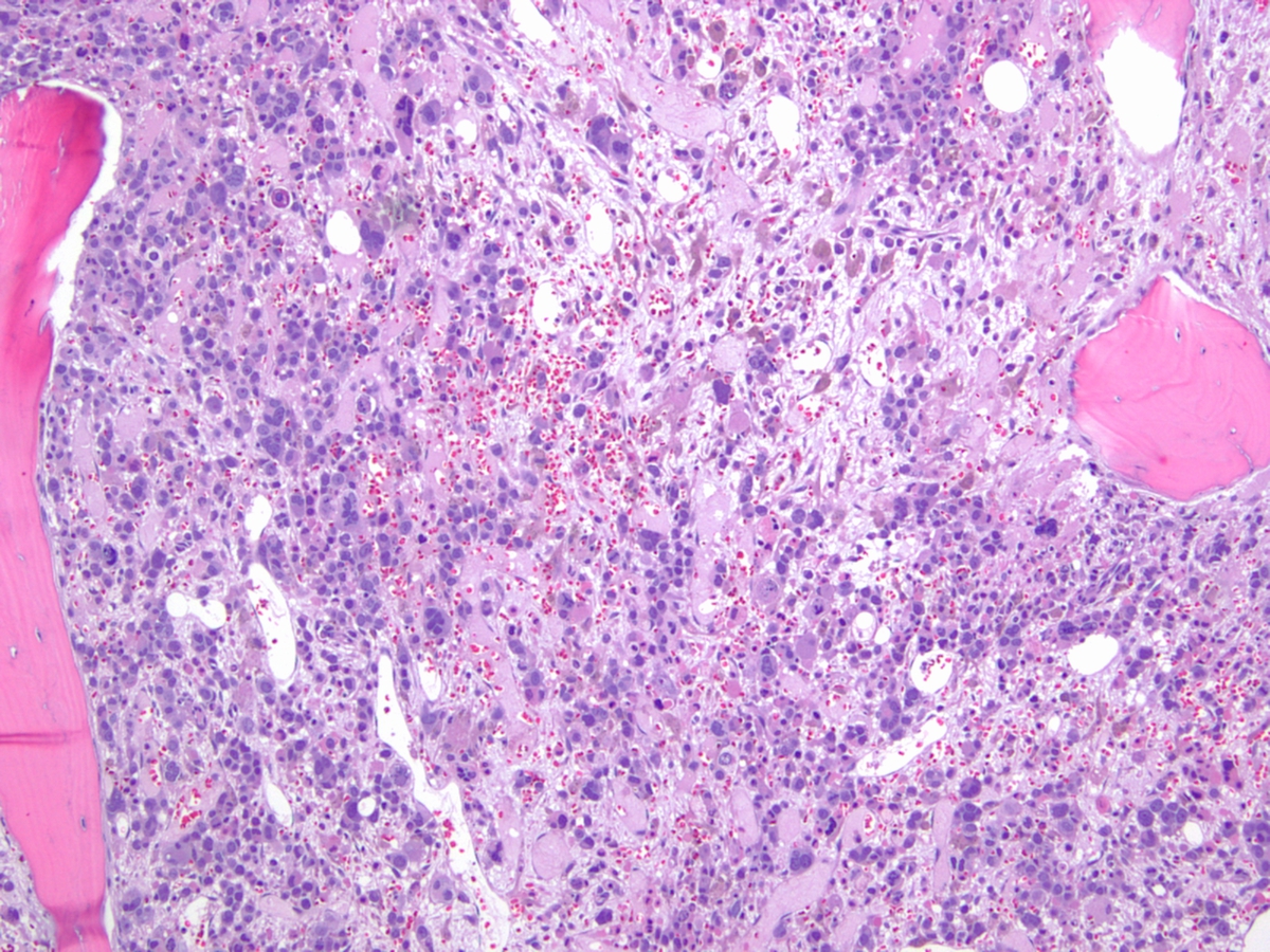 Figure 5. Bone marrow biopsy at day 14 of second induction chemotherapy (H&E, 100x). The cellularity is comprised almost exclusively by abundant large atypical cells with frequent multinucleation, in a background of stromal damage.