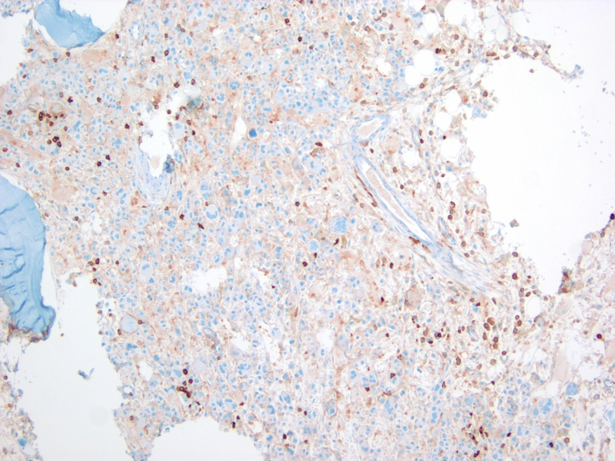Figure 9. Bone marrow biopsy at day 14 of second induction chemotherapy (CD45, 100x). CD45 highlights few scattered small lymphocytes and is negative on the large atypical cells.