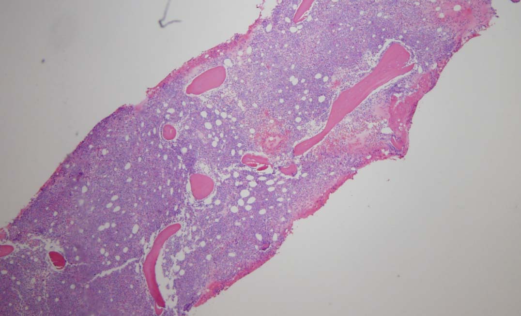 Bone marrow biopsy low power view