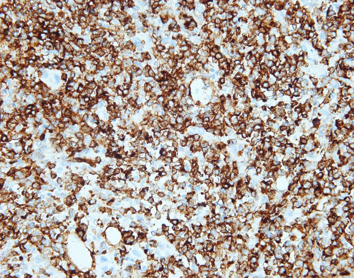 Bone marrow core biopsy, CD34, 40X
