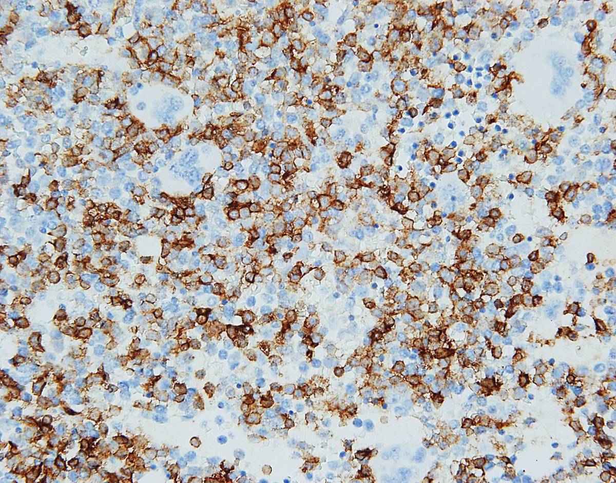 Bone marrow core biopsy, CD56, 40X