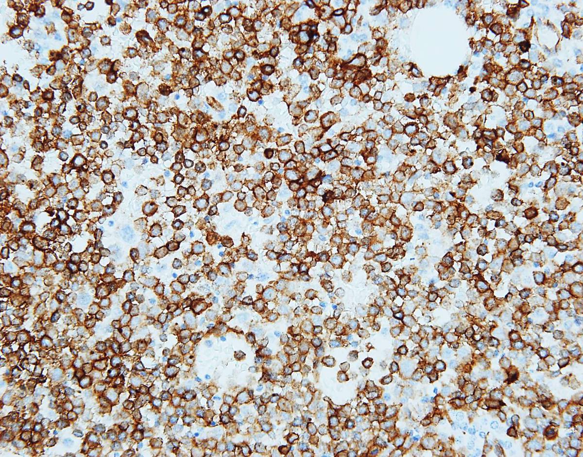 Bone marrow core biopsy, CD123, 40X
