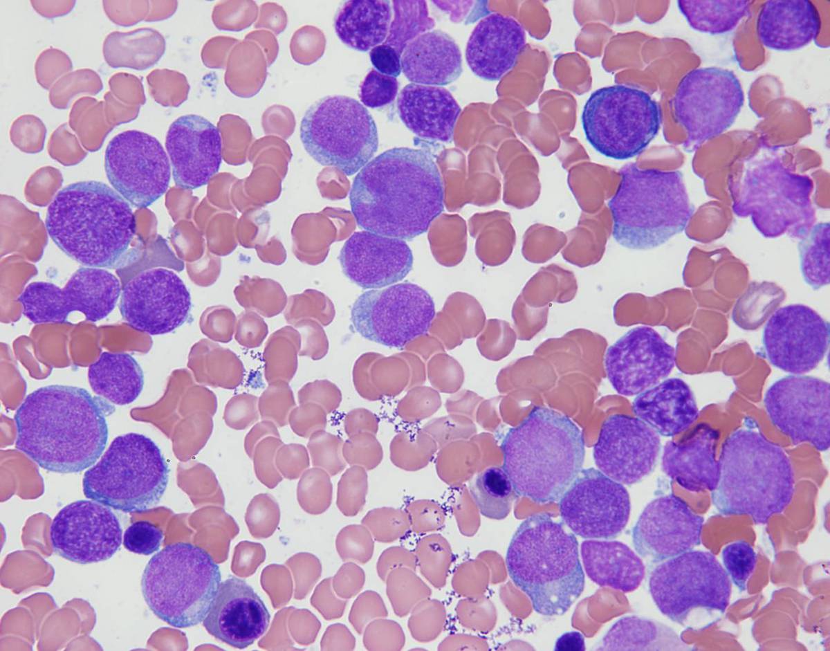 Bone marrow aspirate, Wright-Giemsa stain, 100X