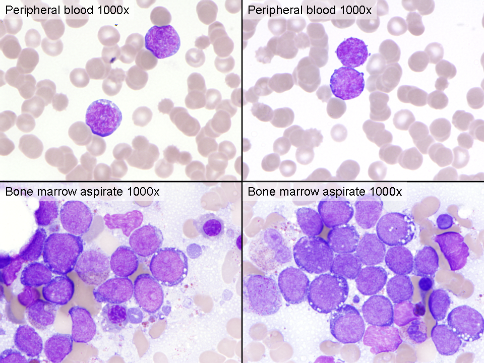 Peripheral blood and bone marrow aspirate smear (1000x)