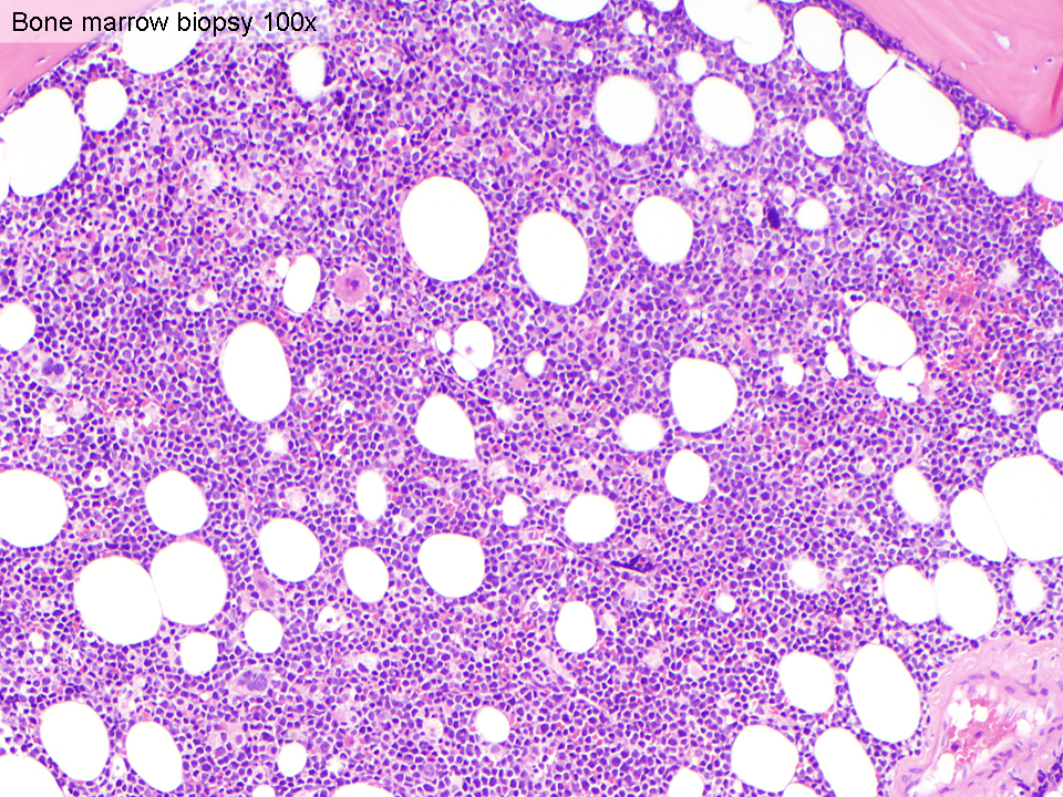 Bone marrow core biopsy (100x)