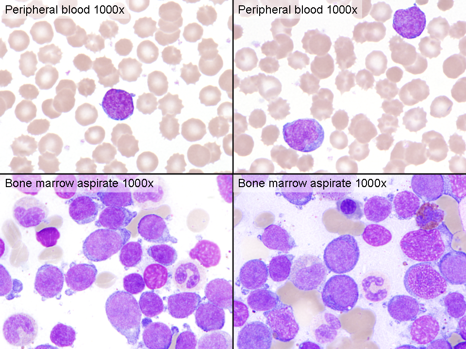 Peripheral blood and bone marrow aspirate smear (1000x)