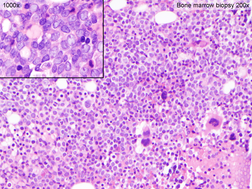 Bone marrow core biopsy (200x; inset 1000x)