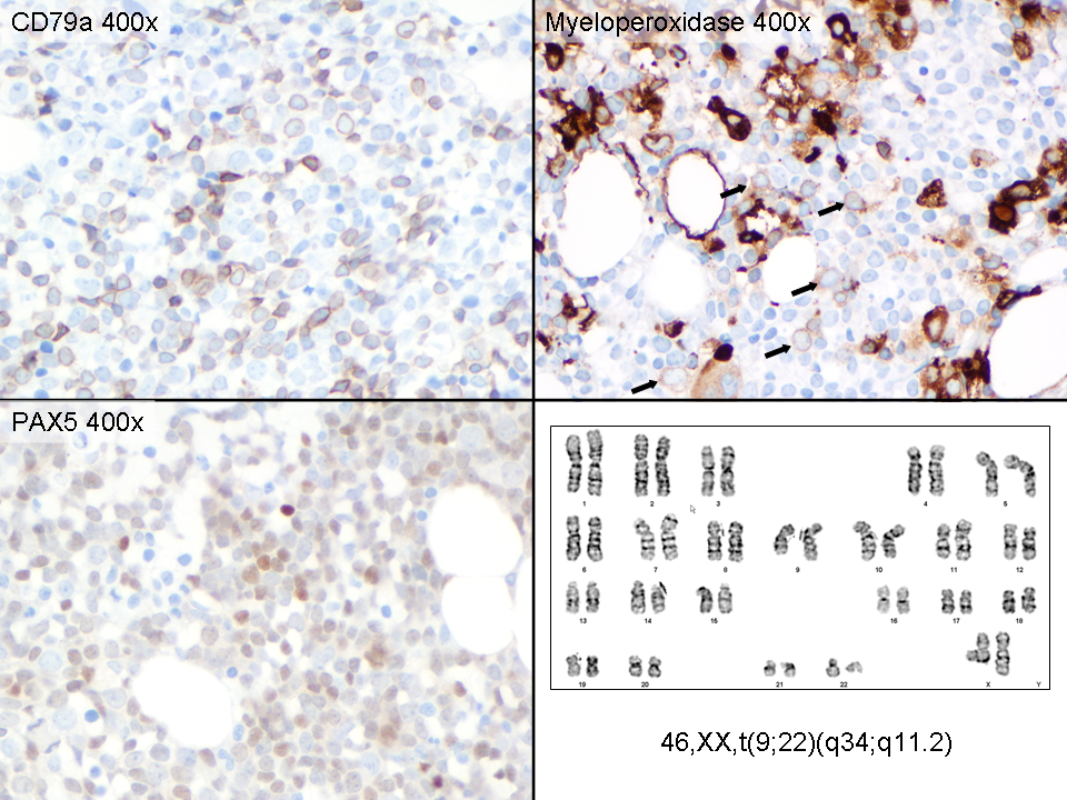 Immunohistochemical stains, bone marrow core biopsy (400x) and karyotype