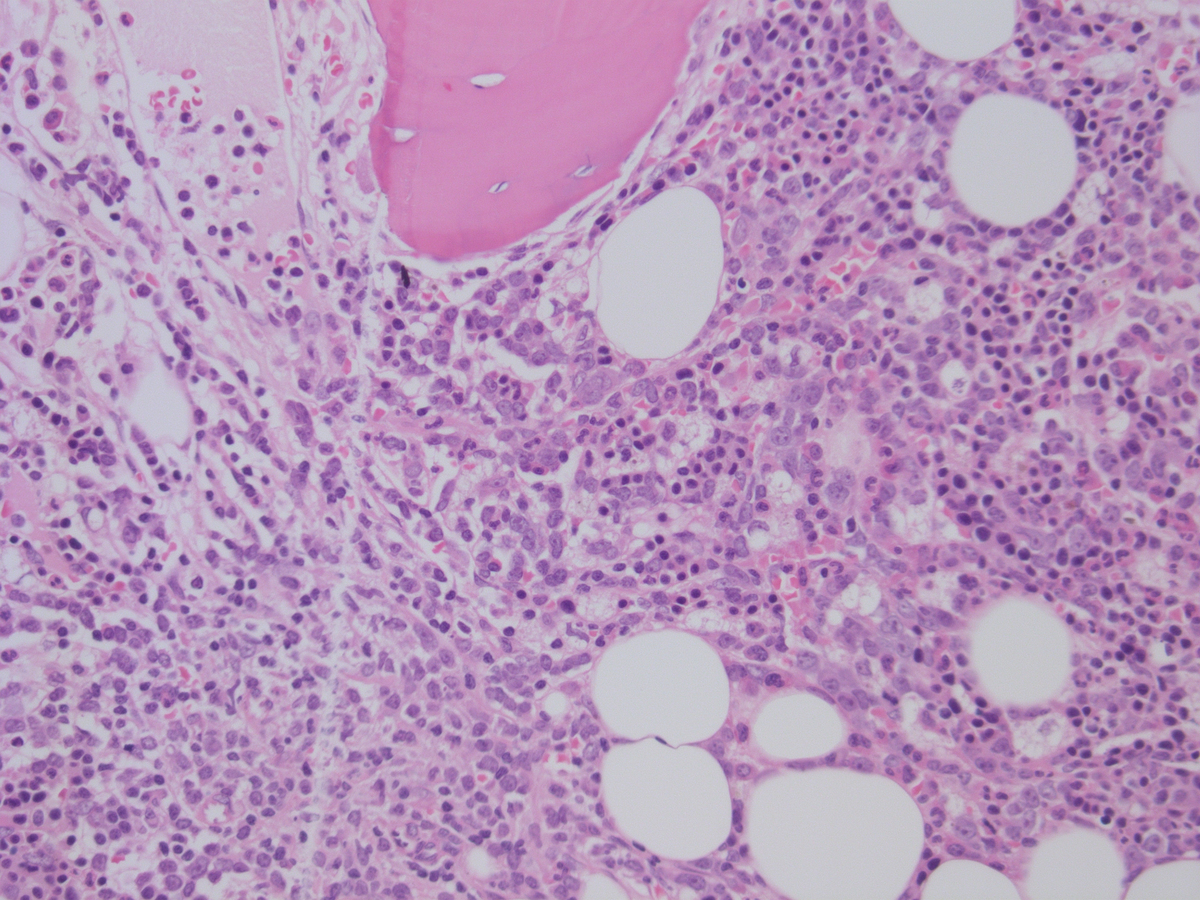 Bone marrow biopsy diagnsotic 5.2012