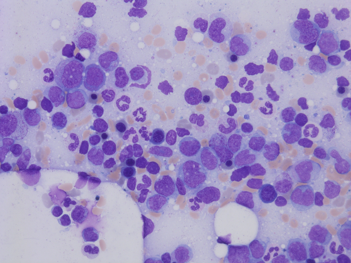 Bone marrow aspirate relapse 1.2013
