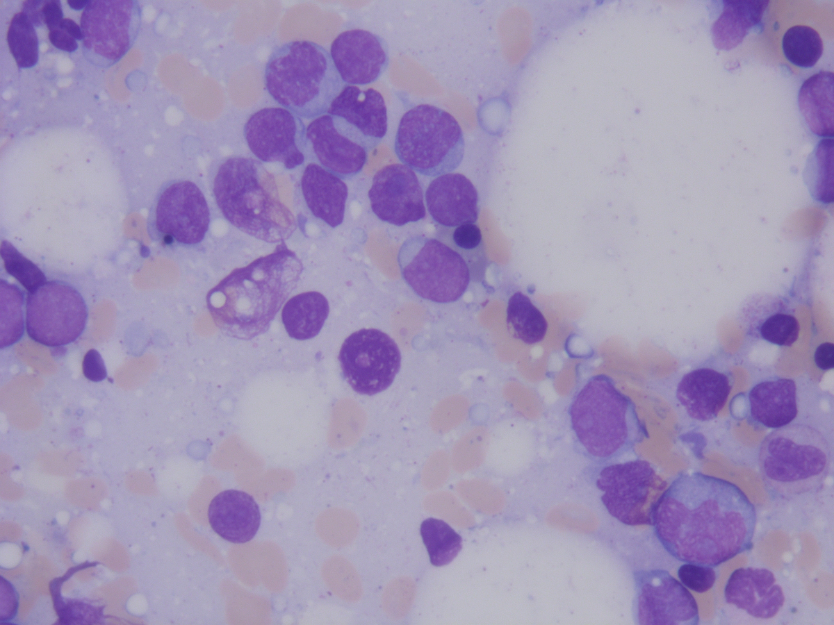 Bone marrow aspirate diagnostic 5.2012