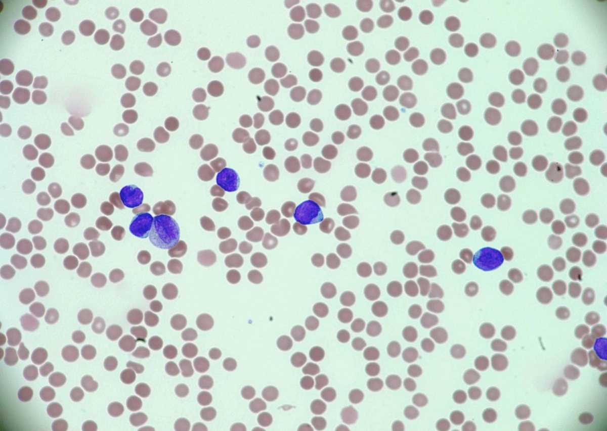 Circulating blasts, peripheral smear