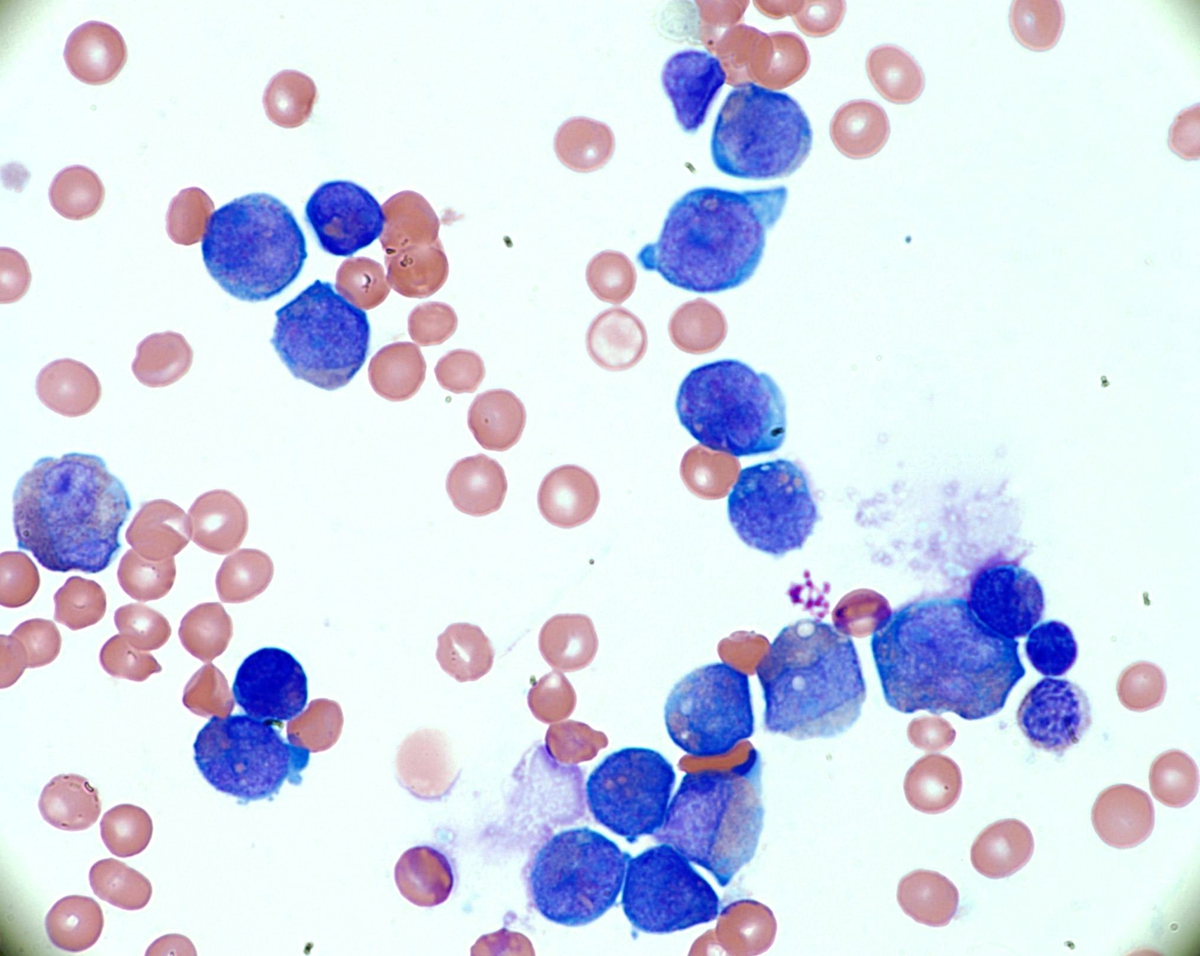 Blasts with abundant azurophilic granules