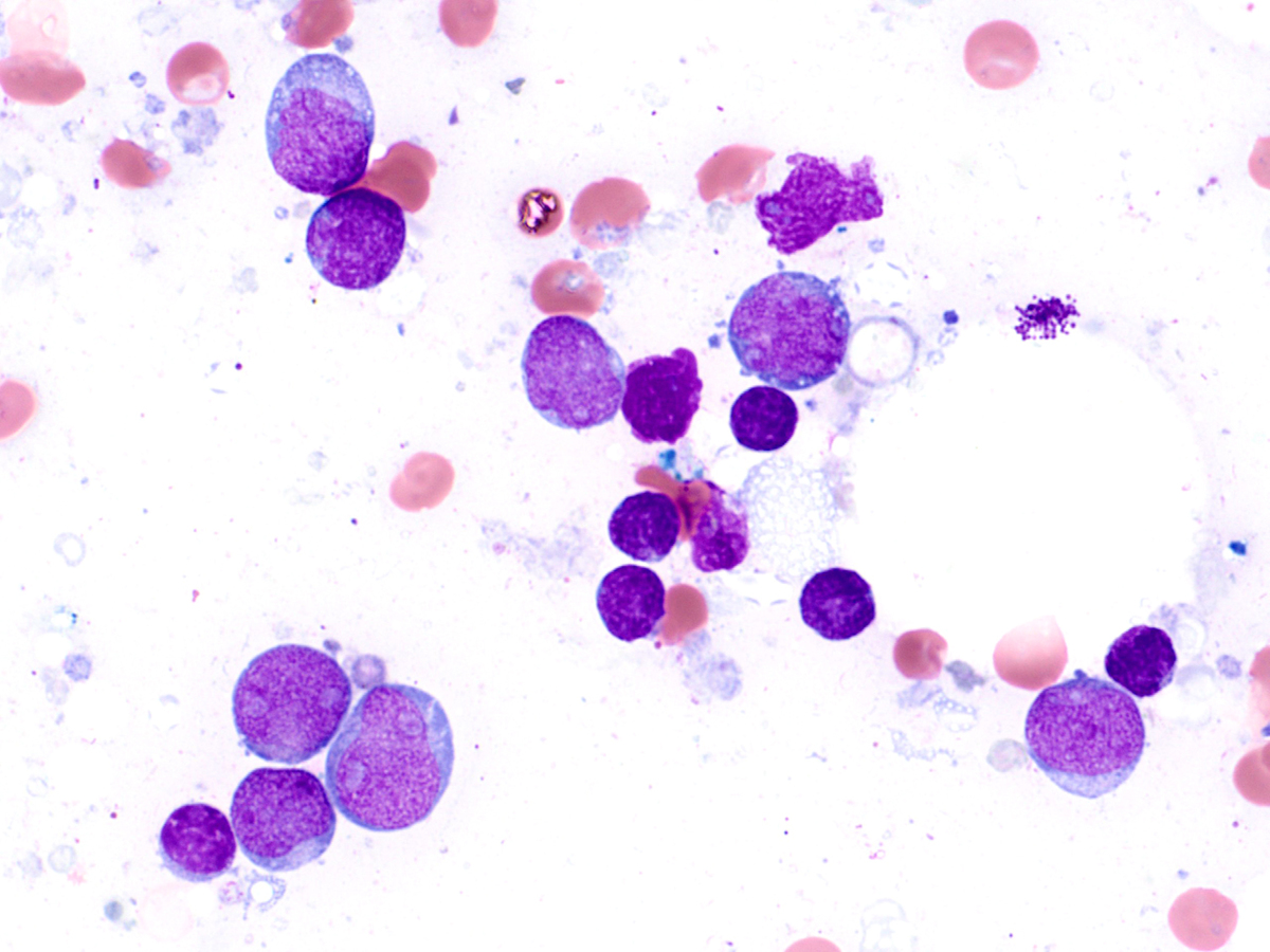 Bone marrow aspirate smear showing morphology of blasts in comparison to mature lymphocytes (Wright-Giemsa, 100x).