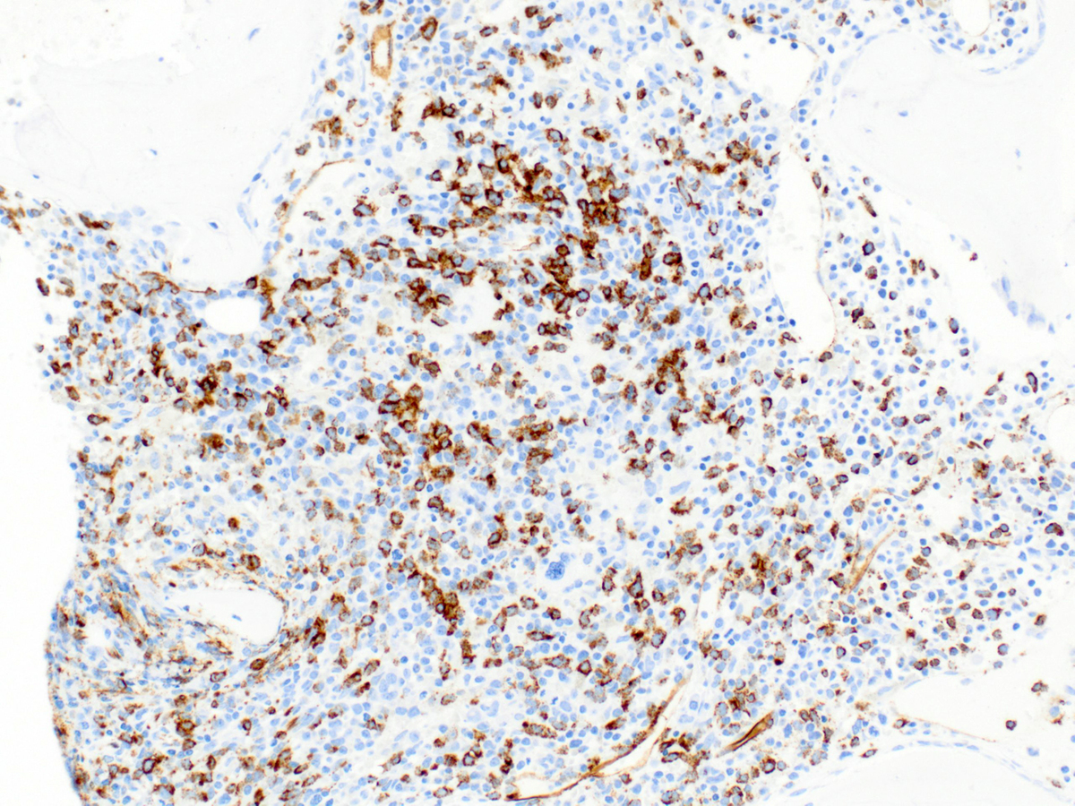 CD34 immunohistochemical stain of core biopsy highlighting blasts (20x).