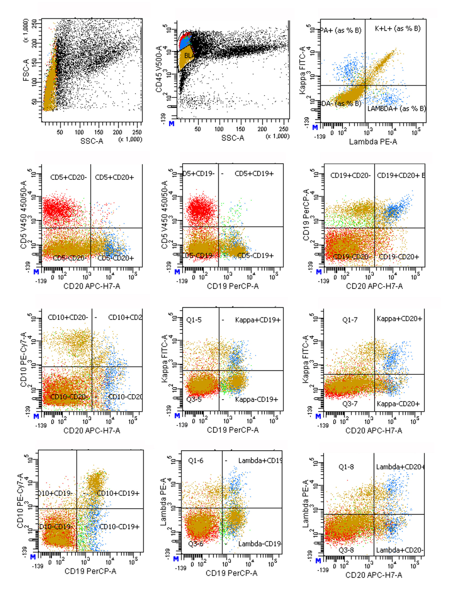 Additional analysis for B-cell antigens shows that the B-lymphoid population (gold) expresses very dim CD20 and is negative for surface kappa and lambda immunoglobulin light chains. Background mature polytypic B cells are present (blue).