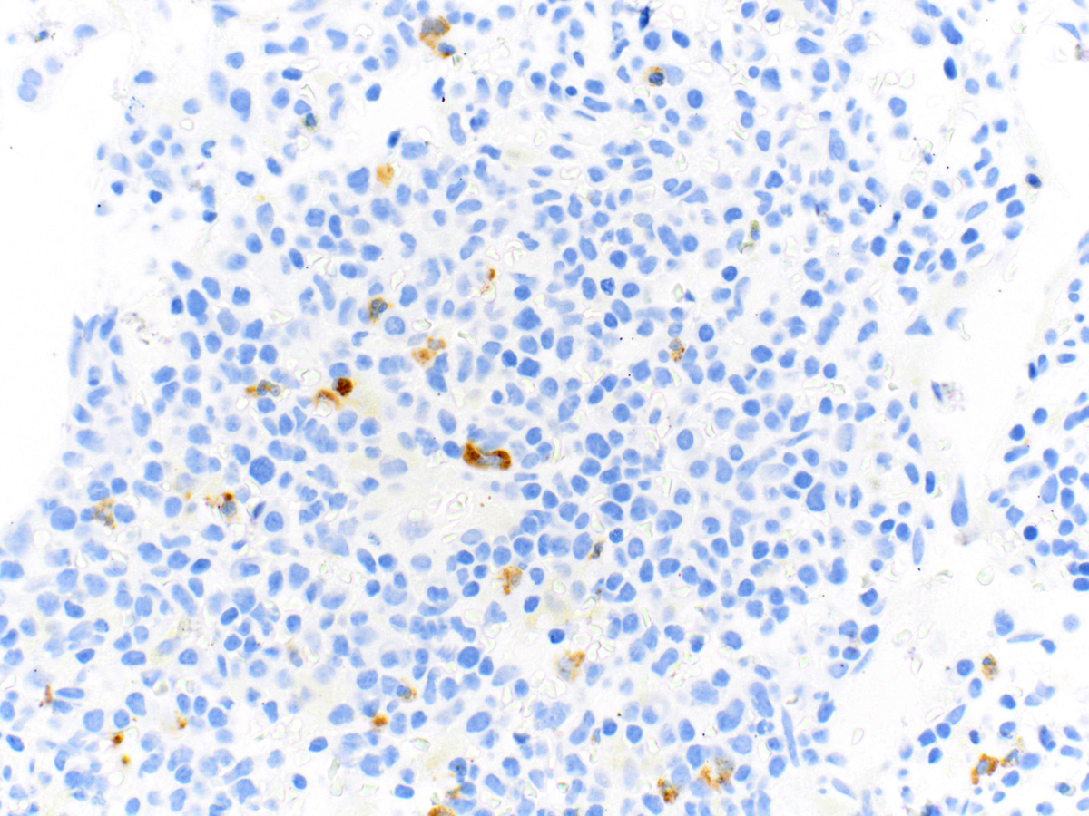 Blasts are negative for MPO by immunohistochemistry (40x).