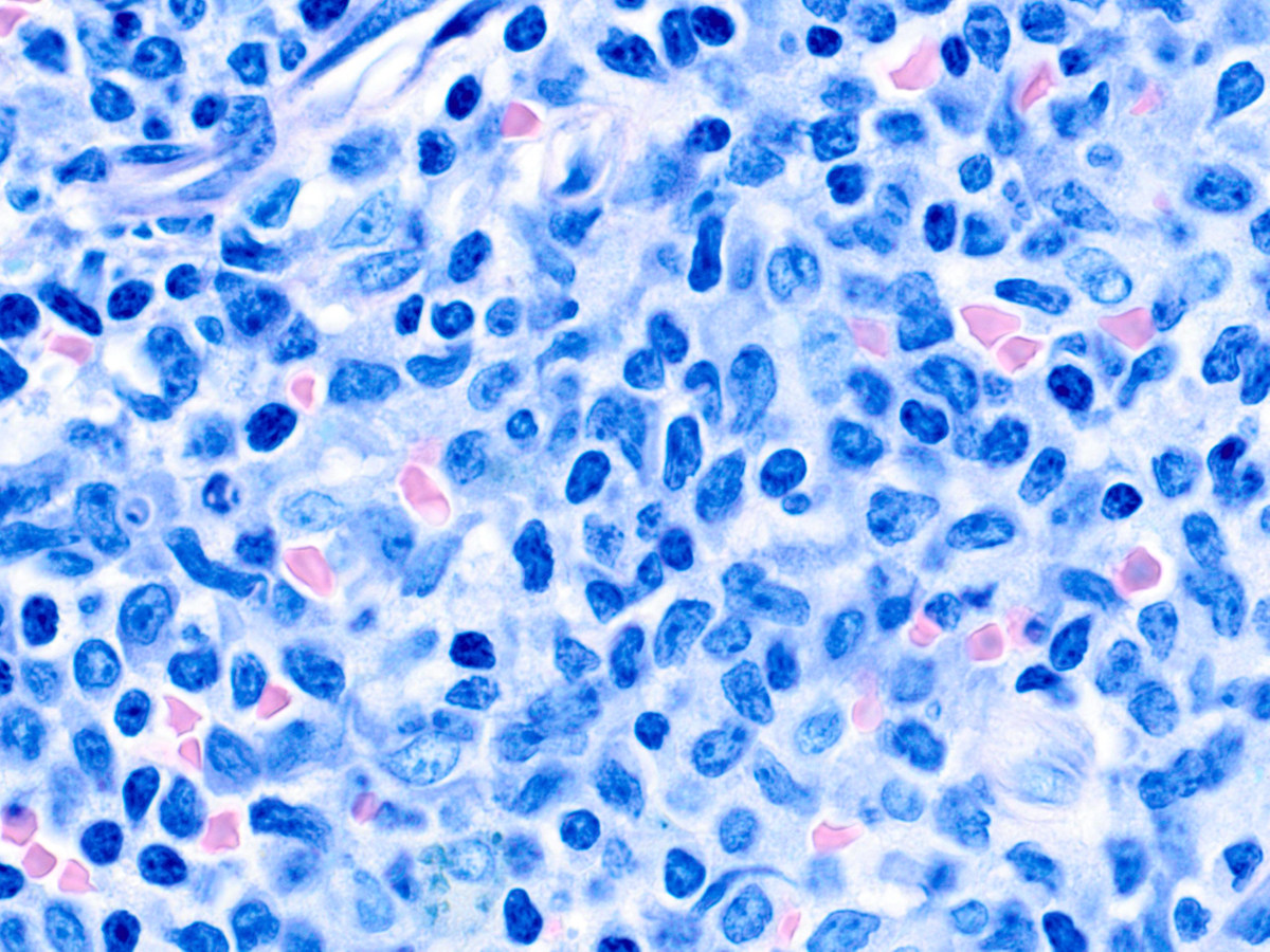 High power view of aggregate of primitive-appearing blasts in core biopsy (Giemsa, 100x).