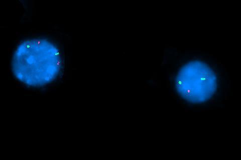 FISH for EGR1 on chromosome 5: Normal signal on left, abnormal signal on right indicating 5q deletion