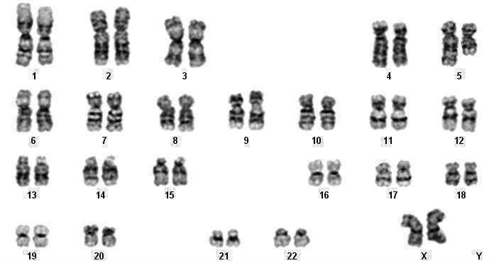 Conventional karyotype identified deletion in the long (q) arm of chromosome 5