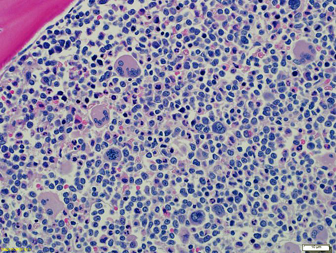 H&E-stained bone marrow trephine biopsy shows a hypercellular marrow with numerous blasts and increased atypical appearing megakaryocytes
