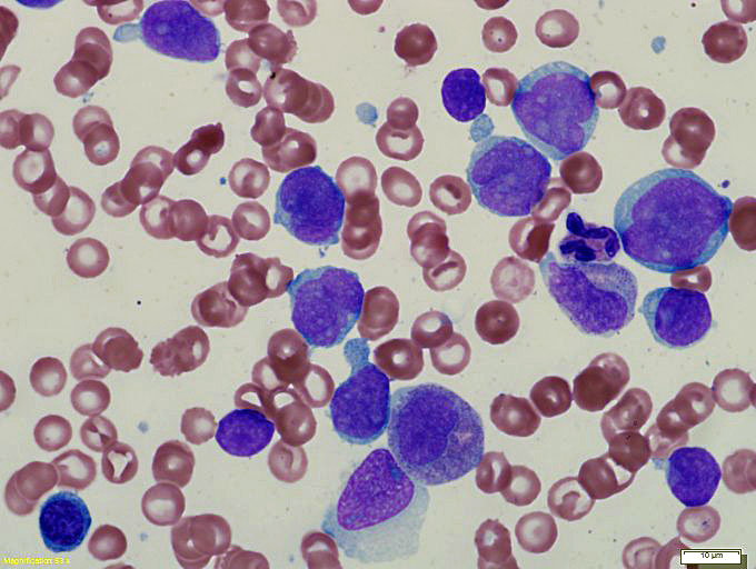 Wright-stained bone marrow aspirate smear demonstrates increased blasts and residual maturing hematopoietic cells