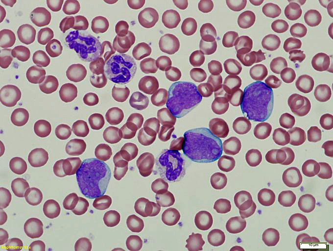 Wright-stained peripheral blood smear demonstrates circulating blasts and thrombocytosis