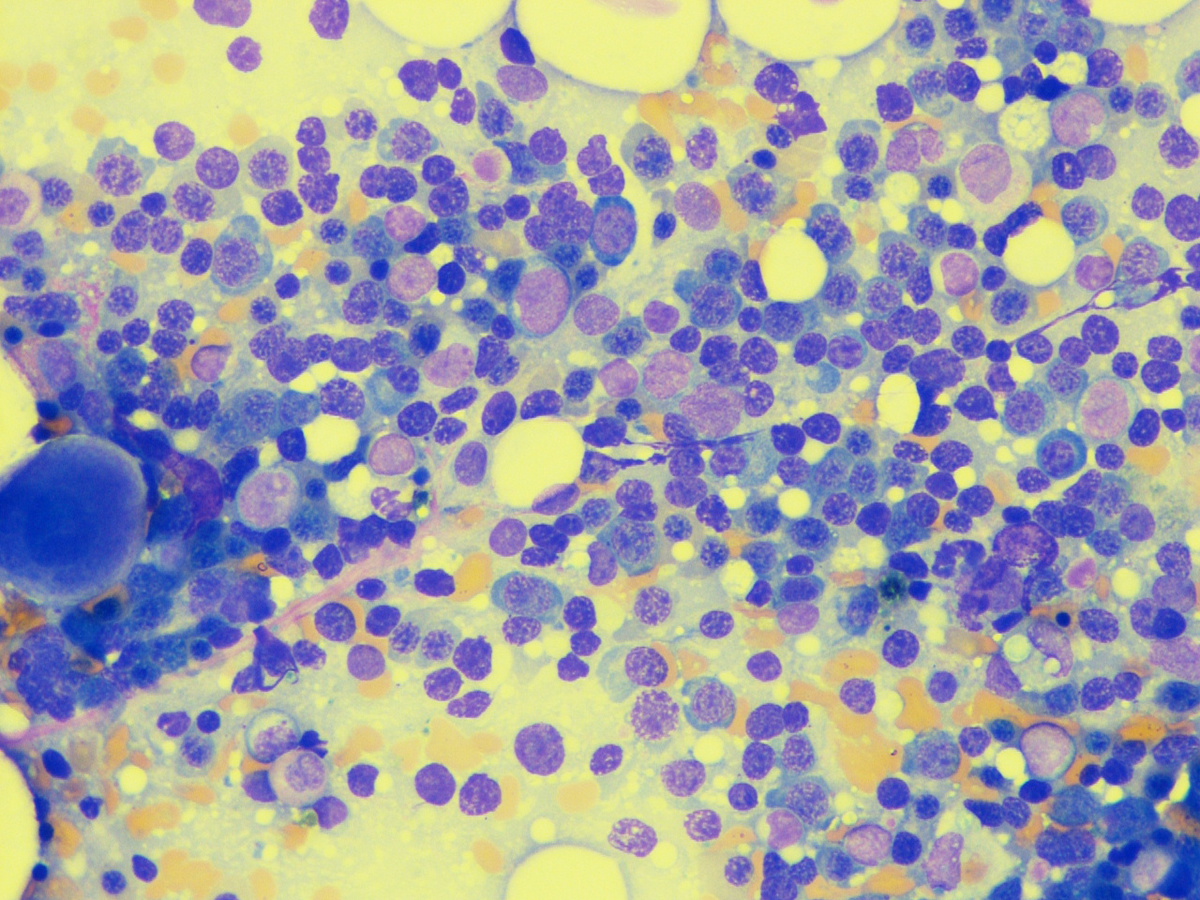 Bone marrow aspirate: numerous erythroid precursors and smaller number of myeloblasts