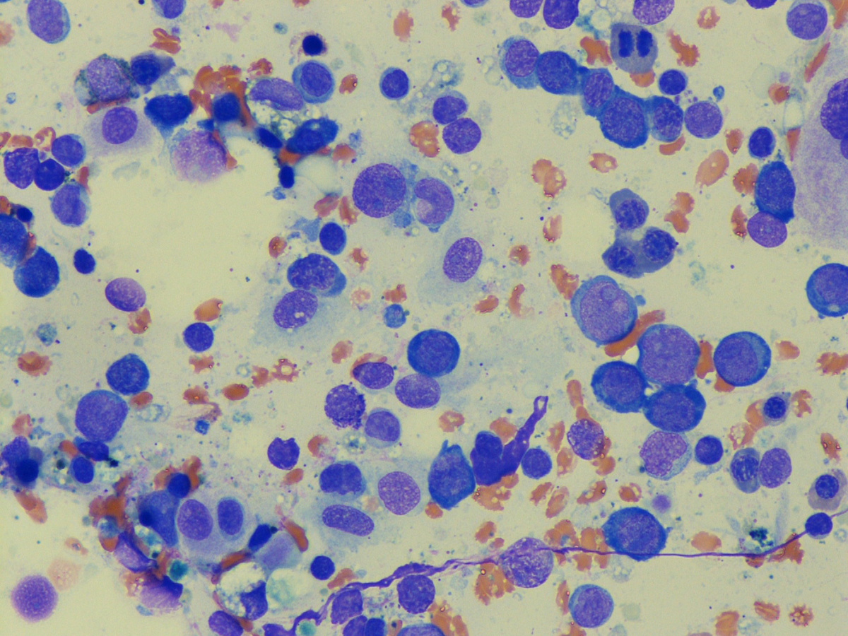 Bone marrow aspirate (#3)