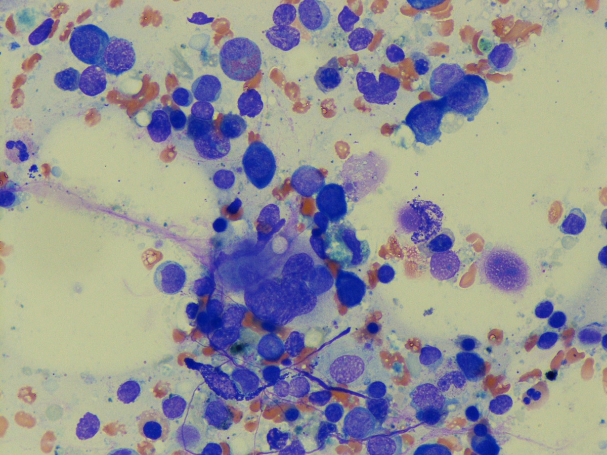 Bone marrow aspirate (#5)
