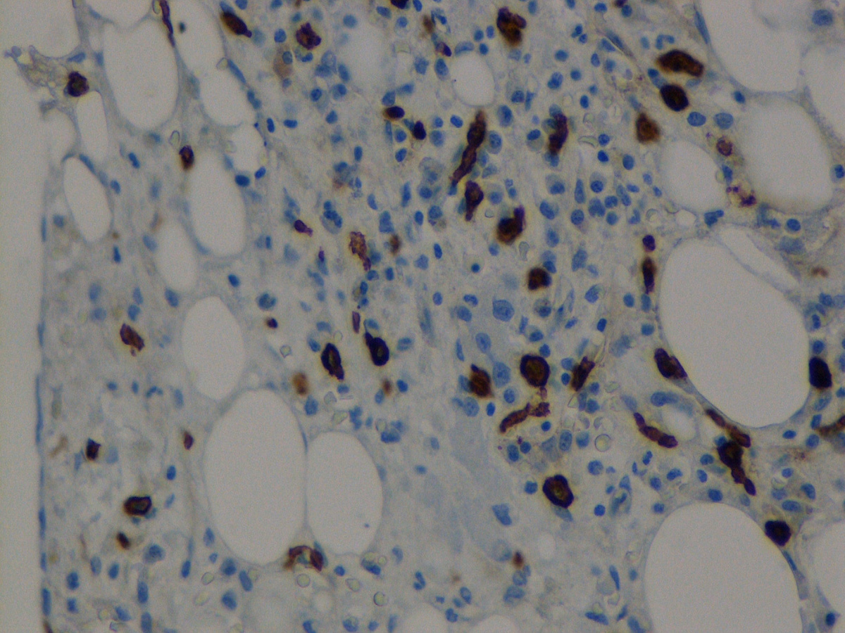 Bone marrow biopsy: CD117immunostain