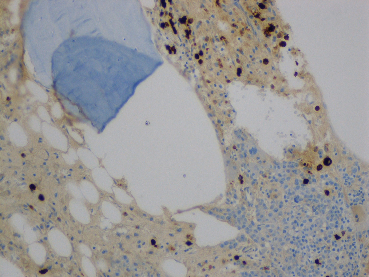 Bone marrow biopsy: Myeloperoxidase immunostain