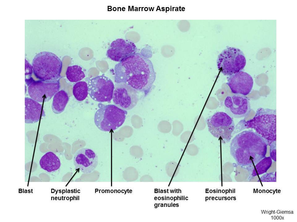 Fig 2 Bone Marrow Aspirate
