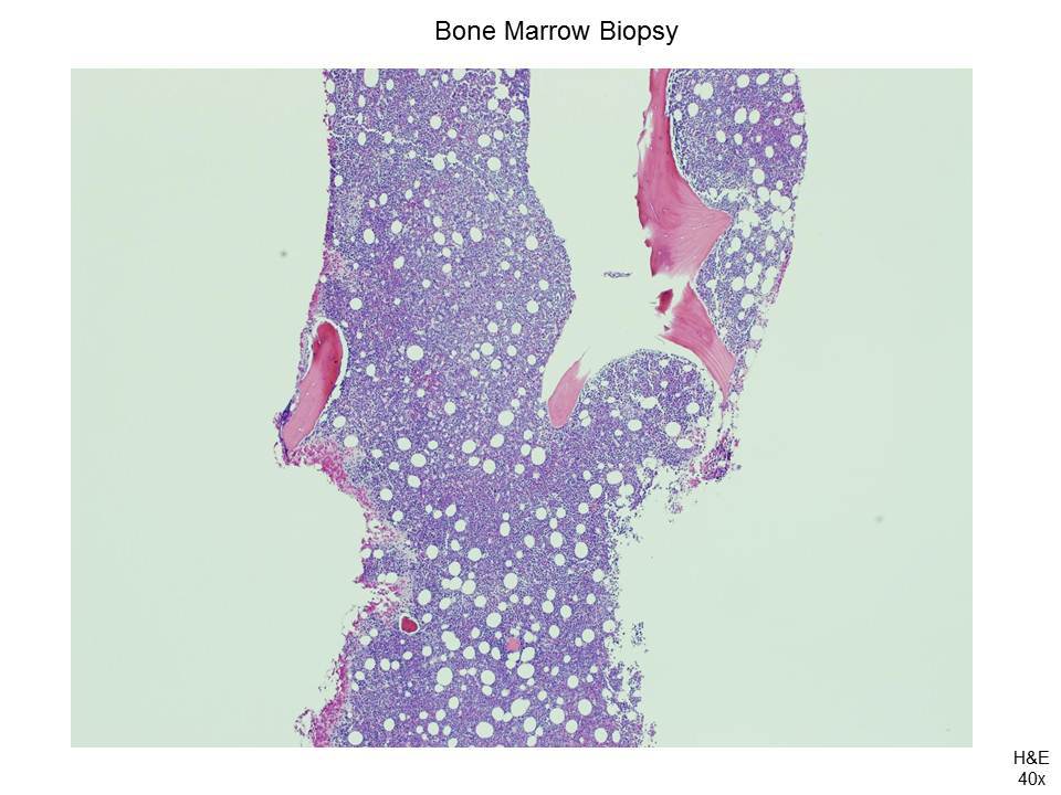Fig. 3 Bone Marrow Biopsy