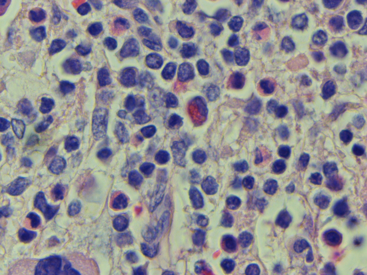 Bone marrow biopsy H&E section #2