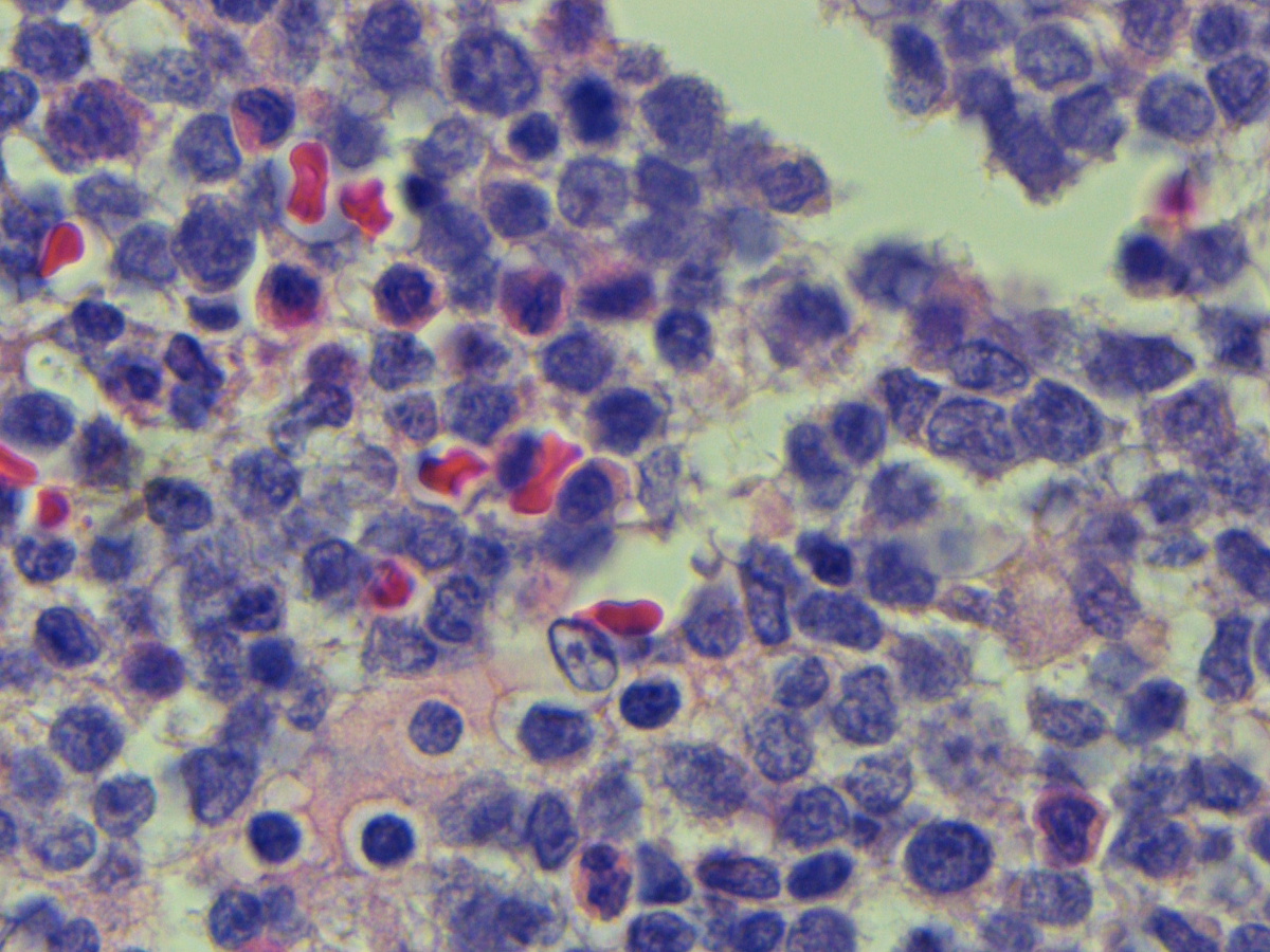 Bone marrow biopsy H&E section #3