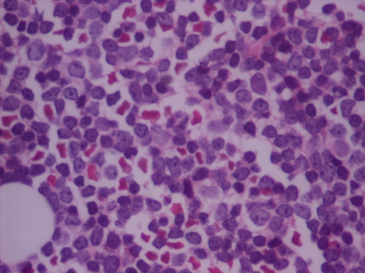 BM biopsy 2012