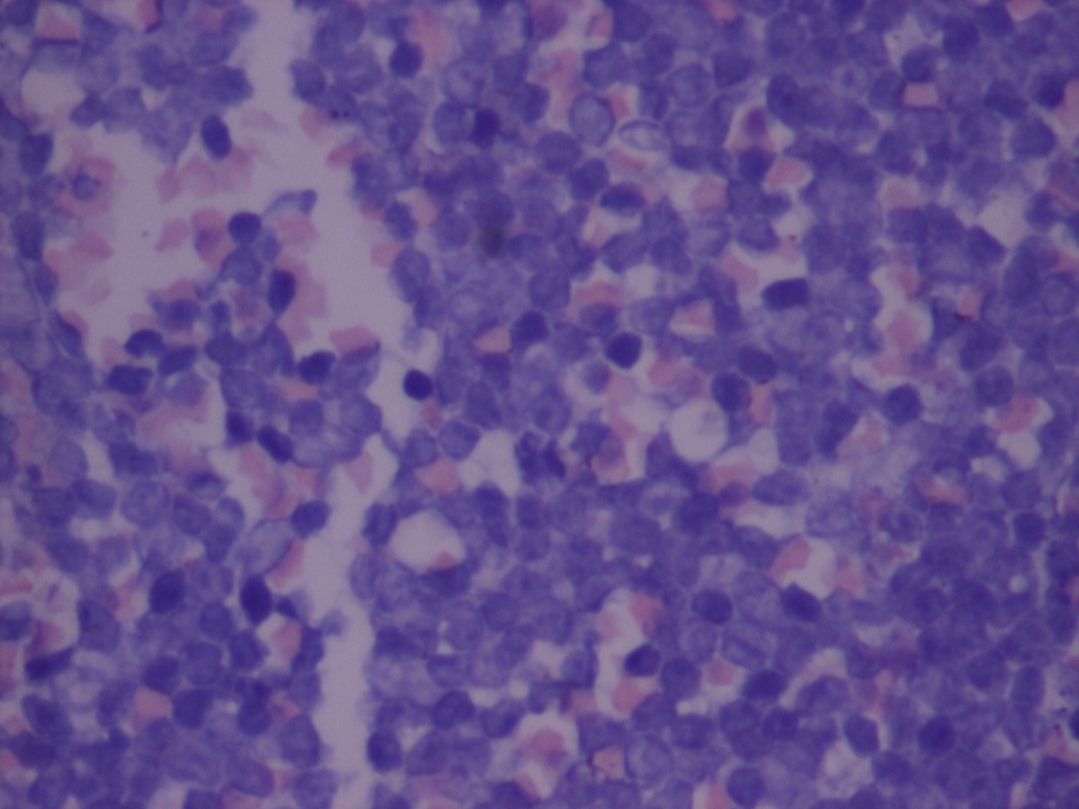 BM biopsy 2012-Giemsa stain