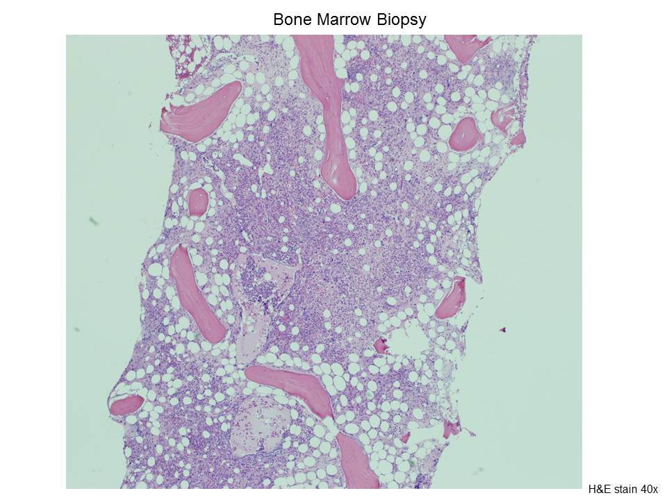 Fig. 3 Bone Marrow Biopsy
