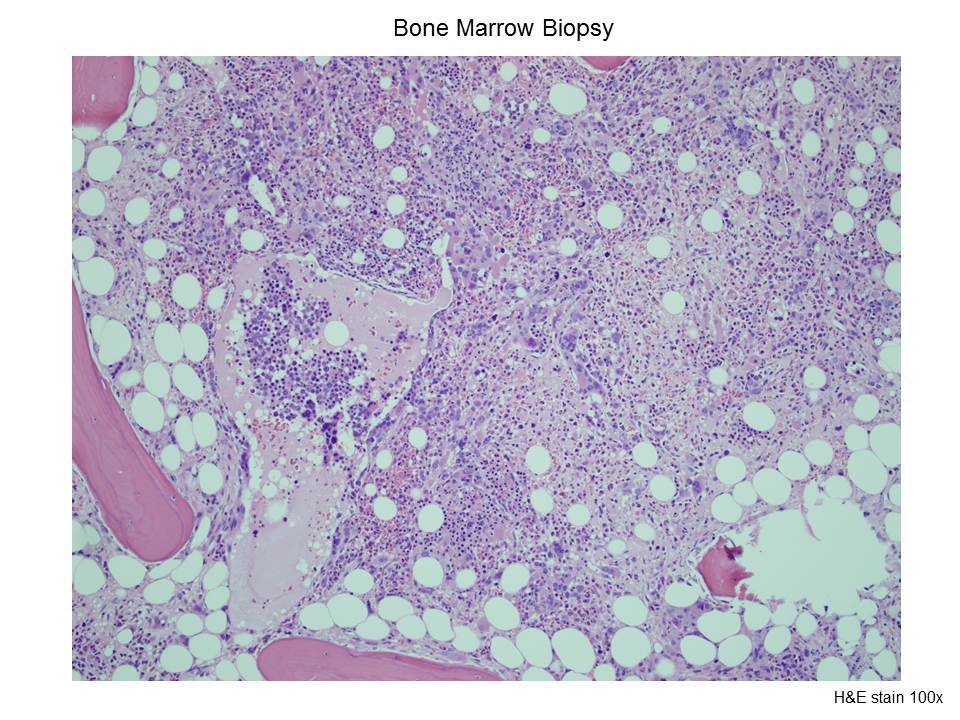 Fig. 4 Bone Marrow Biopsy